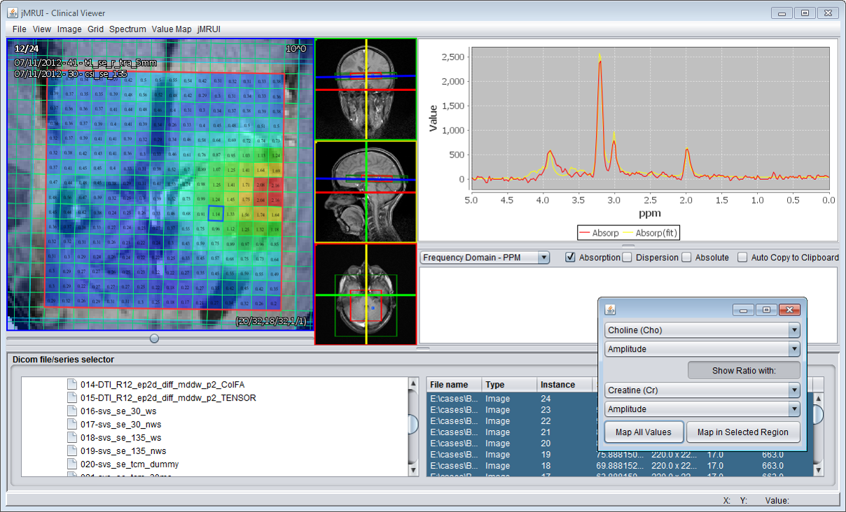 New jMRUI Clinical Viewer plug-in for MRS and MRSI: Cho/Cr metabolite map in a GBM-patient brain (quantified with QUEST), 1.5T, TE = 135 ms.